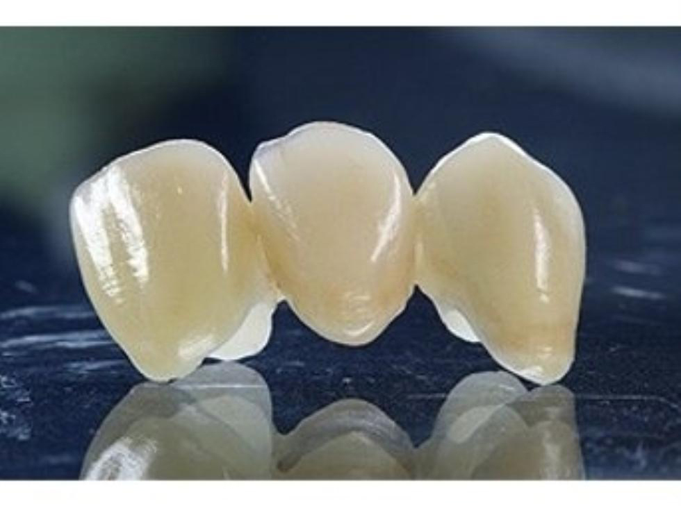 стоматологічні мости та коронки