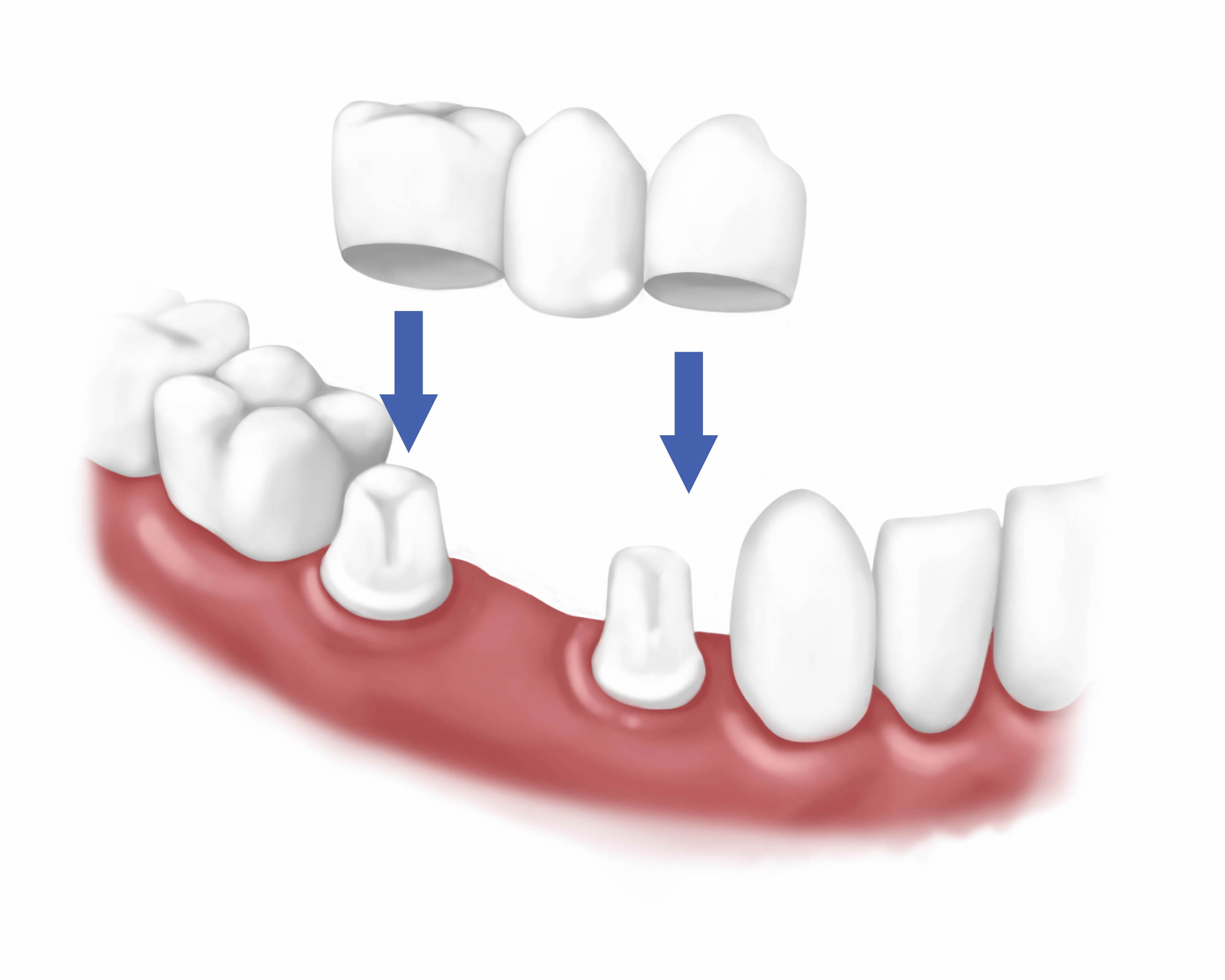 суцільнокерамічний штучний зуб