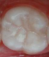 композитна пломба