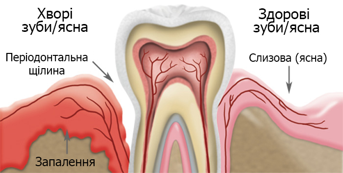 Захворювання ясен