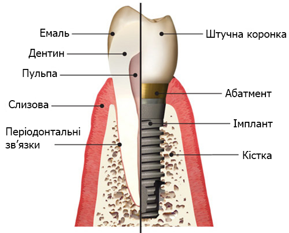 Стоматологічні імпланти