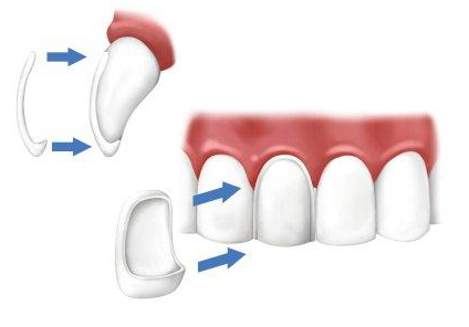 постановка вінірів