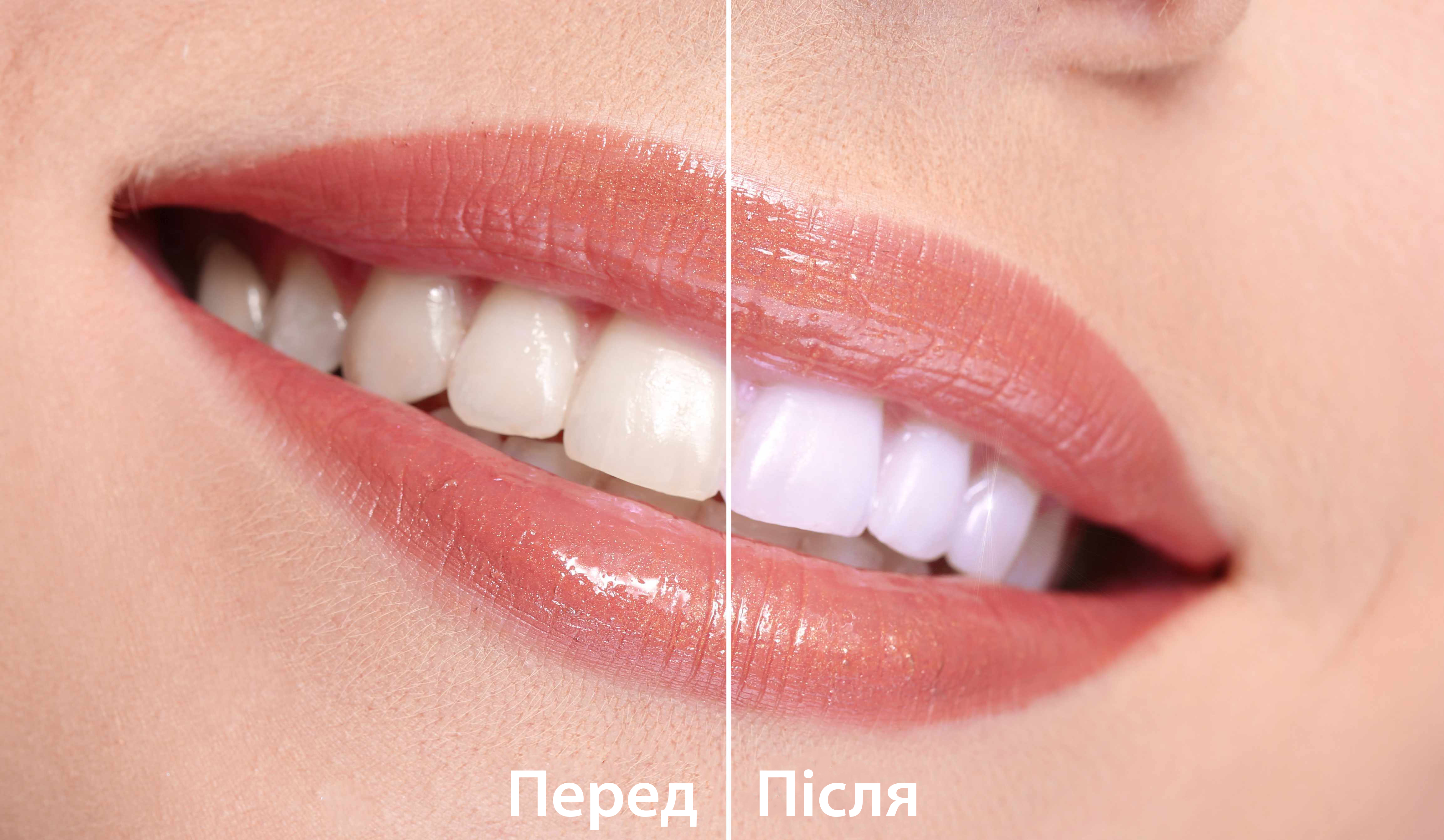 відбілювання зубів